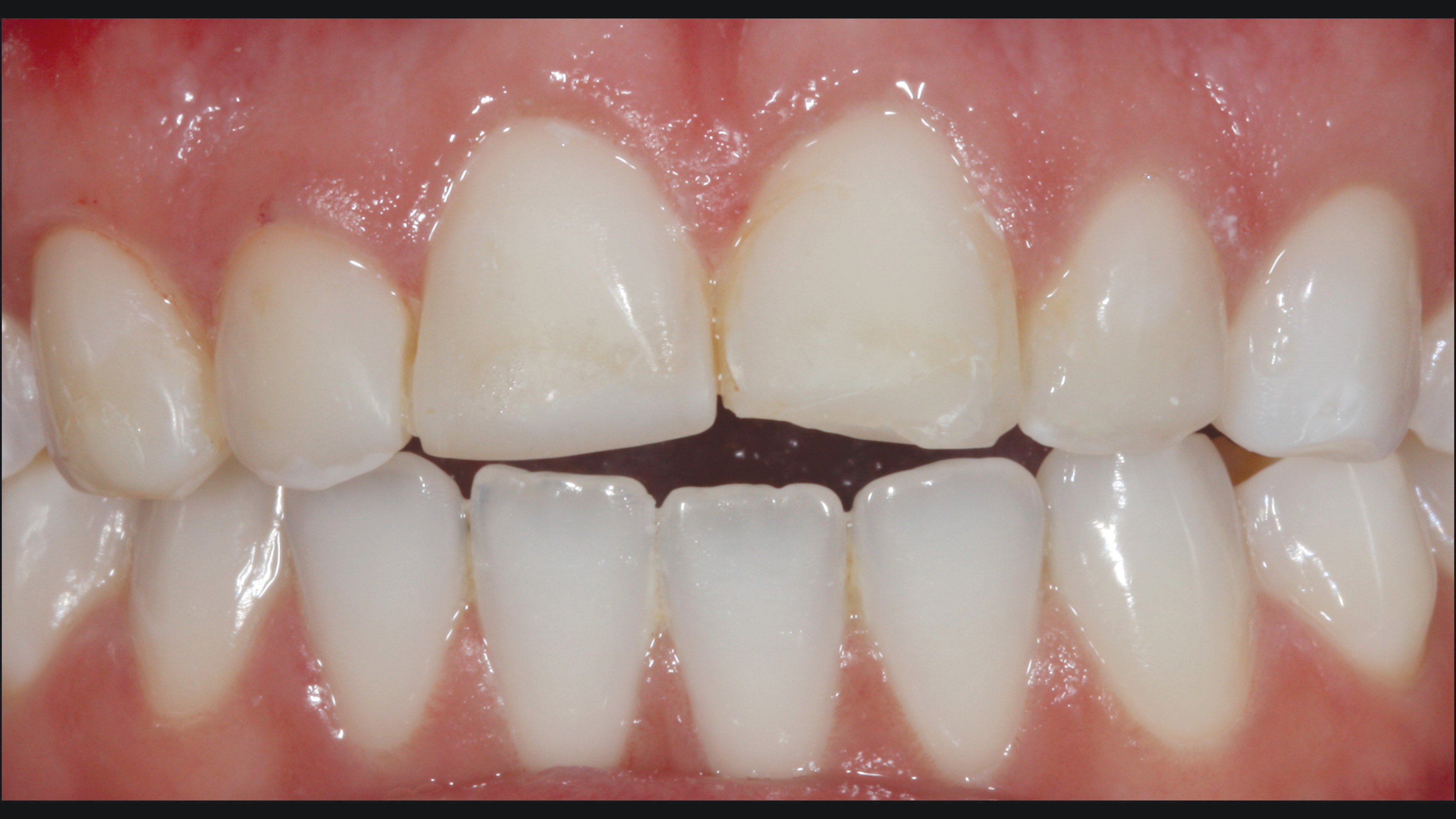 Clinical_Direct_Indirect_Transcend_Dr.J_1123_0