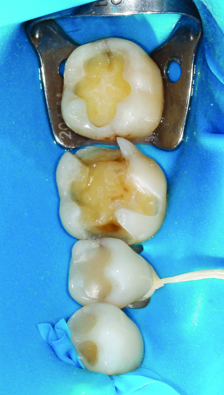 Clinical Guide: Transcend Composite