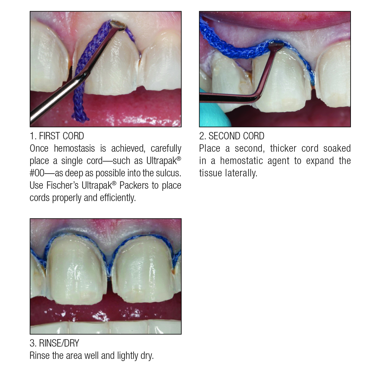 thumbnail image 2 of DSI Gingival Retraction Cord - Epinephrine Impregnated, Twisted (3x112 Inches) 2 of 4