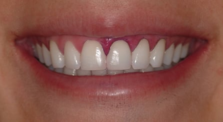 After rinsing, Dr. Morgan applied plaque indicator to the patients’ teeth to show the effectiveness of the charcoal. The purple residue indicates leftover plaque on the patient’s teeth.