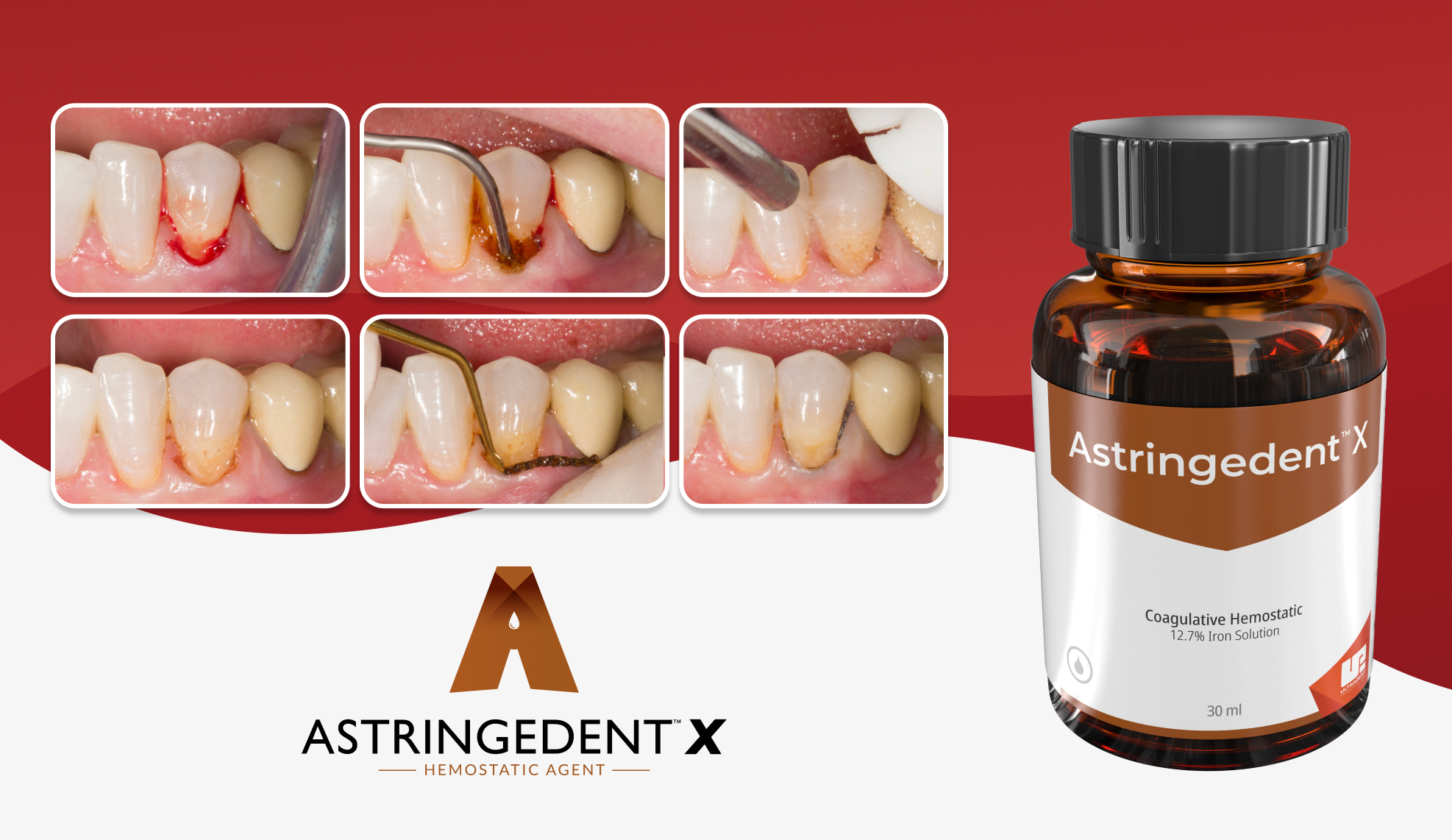 Clinical step by step of Astringedent X with a picture of the product and brand logo.