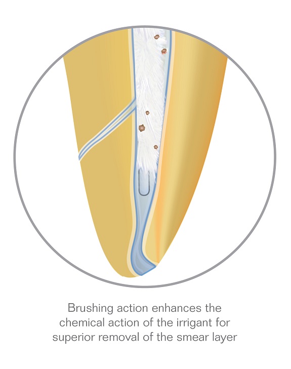 Brushing action enhances the chemical action of the irrigant for superior removal of the smear layer.
